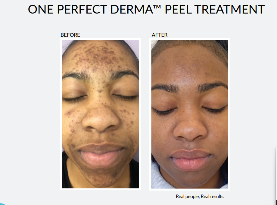 Perfect Derma Peel — Toronto Pop-Up (Advanced Correction)