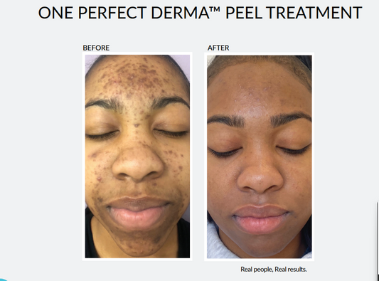 Perfect Derma  peel