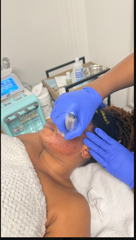 Microneedling Treatment — Toronto Pop-Up